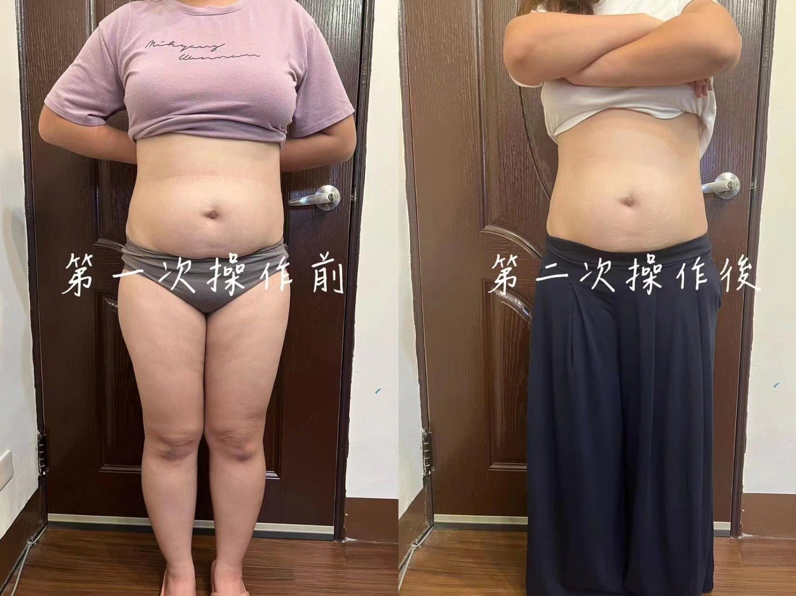 Cryolipolysis treatment documentation example one