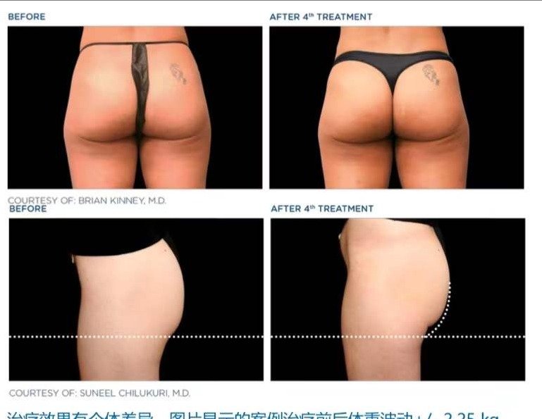 Cryolipolysis treatment documentation example two