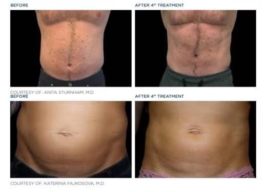 Cryolipolysis treatment documentation example three