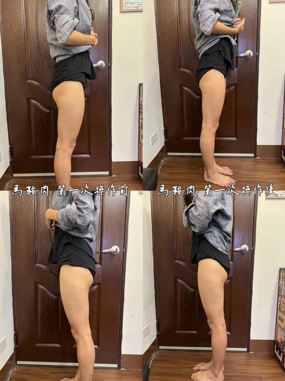 Cryolipolysis treatment documentation example four